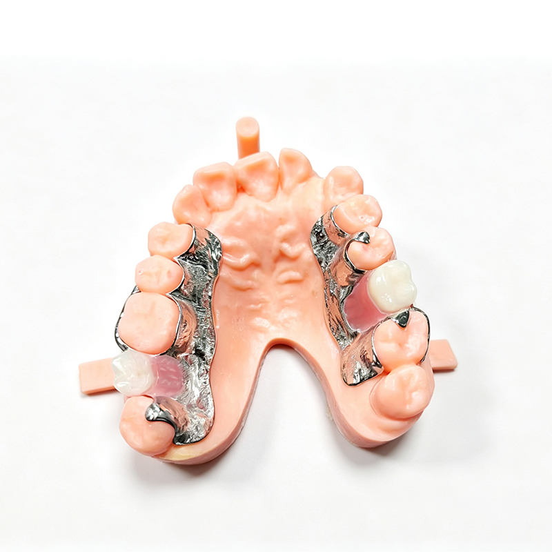 Metal‑Base Partial Dentures - 图片 2