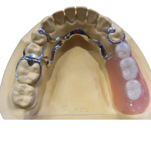 Metal‑Base Partial Dentures