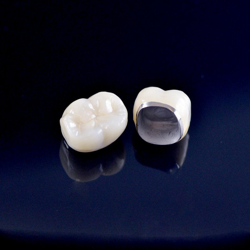 Porcelain‑Fused‑to‑Metal Crowns