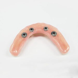 Screw‑Retained Hybrid Denture
